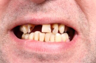 Почему у алкоголиков плохие зубы: причины